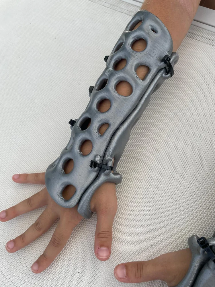 Ortesis gris colocada sobre la mano, la muñeca y el antebrazo