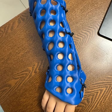 Yeso 3D azul colocado en el antebrazo y la muñeca; fotografía del blog original del Dr. Vega